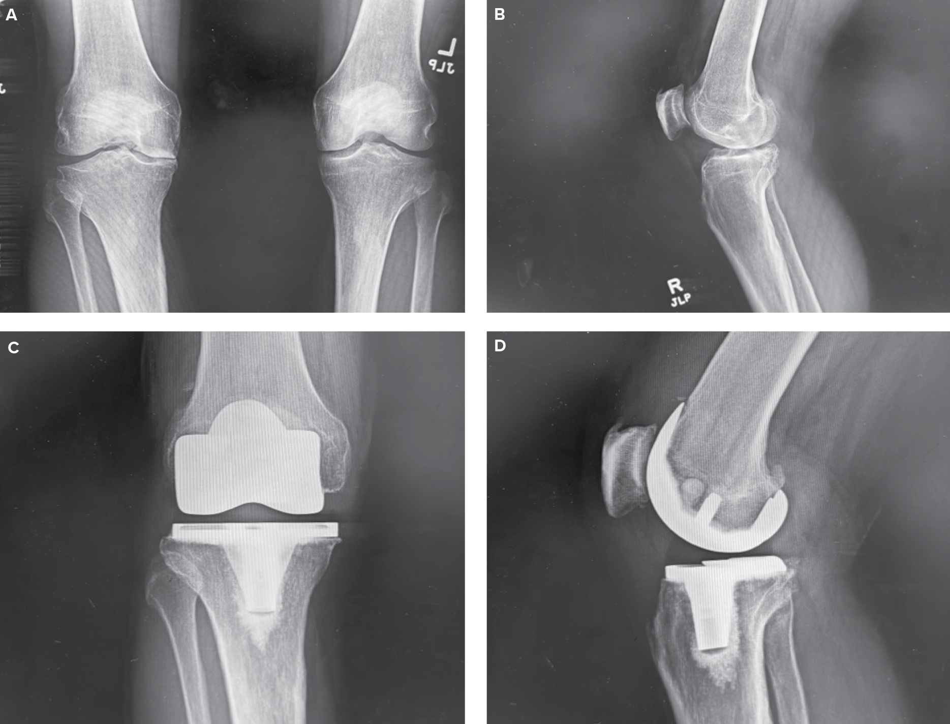 Board Approves CPGs for Surgical Management of Knee Osteoarthritis and