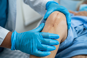 Total Joint Arthroplasty